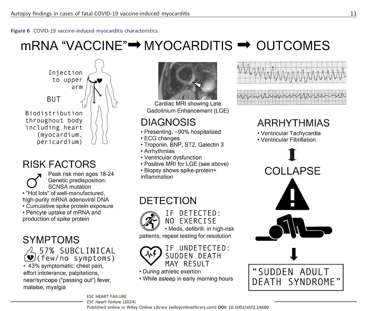 Autopsy results of fatal myocarditis caused by the COVID-19 vaccine