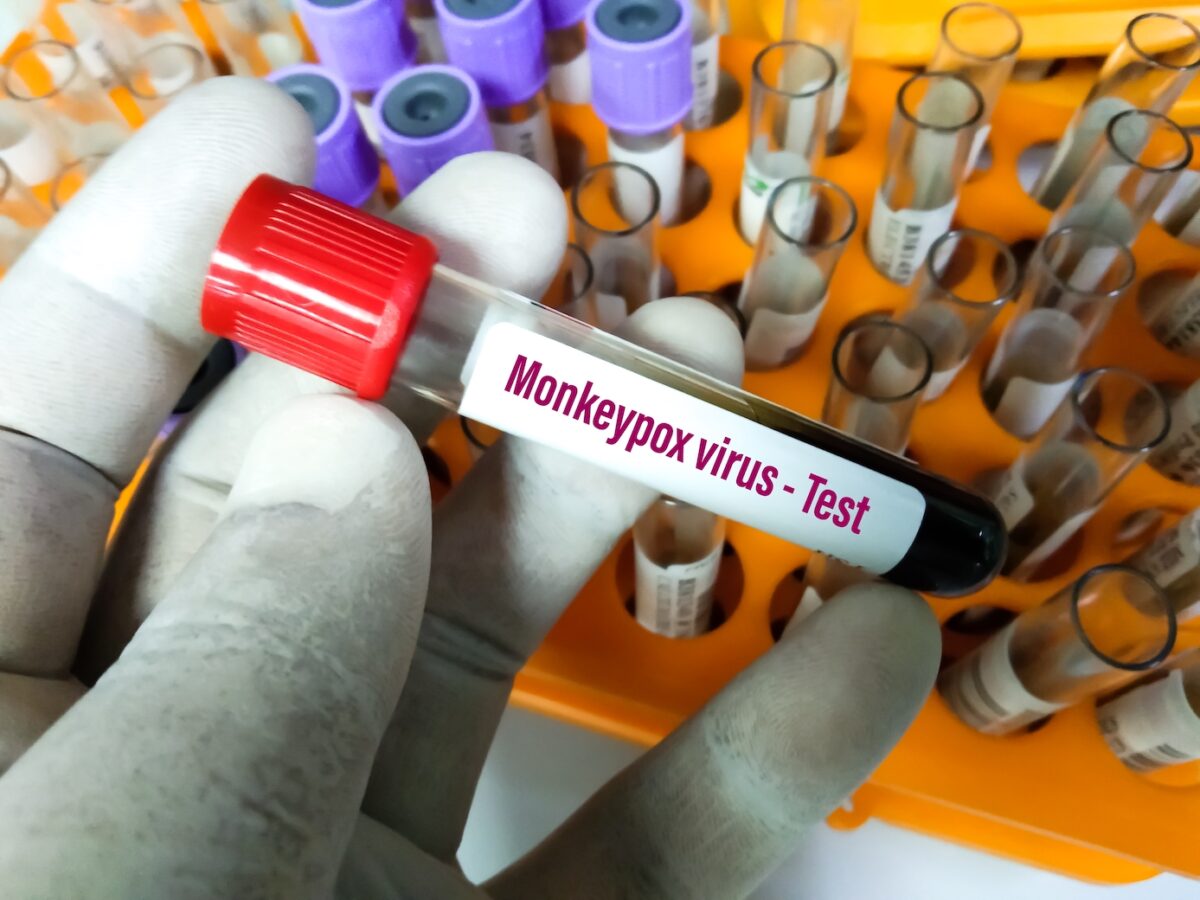 Monkeypox Virüsü: Gerçekler ve Korku Monkeypox Virüsü: Gerçekler ve Korku